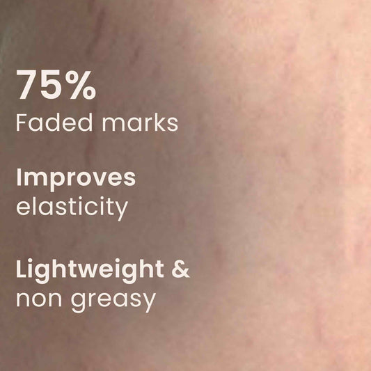 Anti Stretch Marks Cream