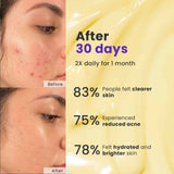 Acne Erase Cream