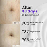 Anti Stretch Marks Cream