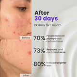 Acne Defense Pack: Acne Erase Cream+ Acne Shield Moisturizer